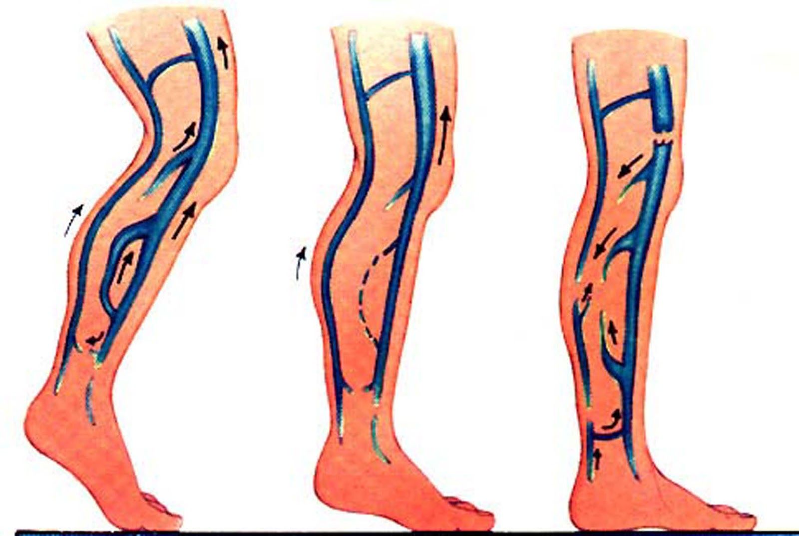 UNA NUOVA TECNICA CHIRURGICA NEL TRATTAMENTO DELLA SINDROME POST TROMBOTICA
