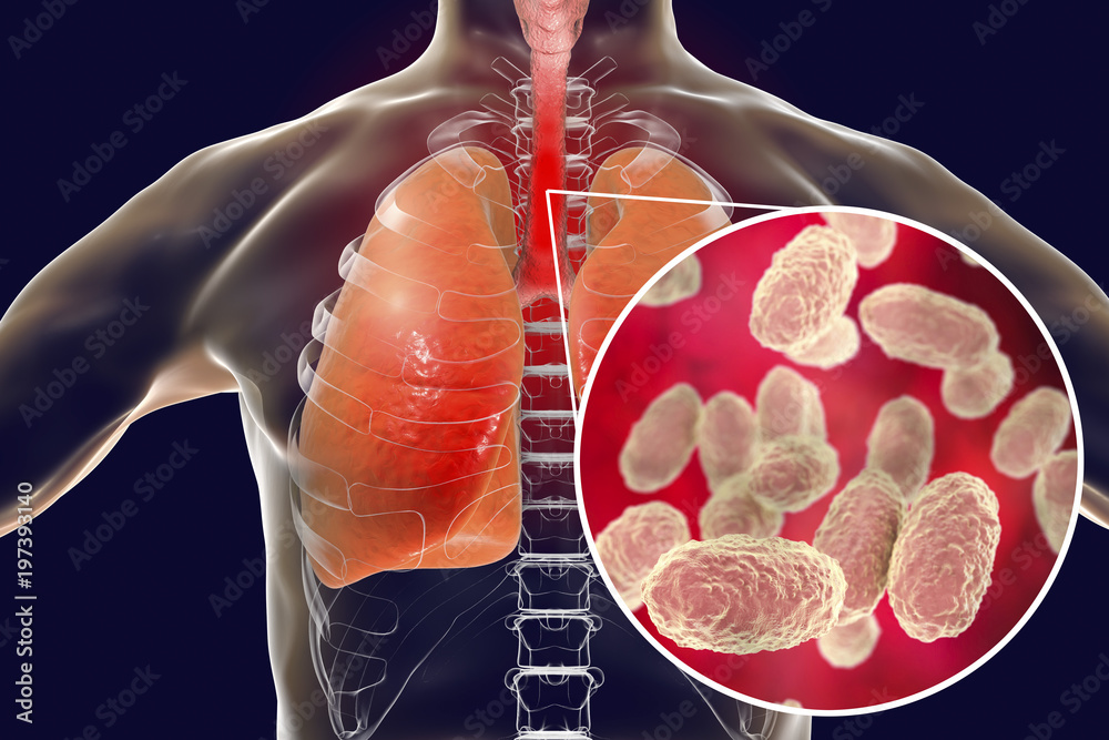 Diagnosi e trattamento della sclerosi multipla e della sclerosi laterale amiotrofica: neuropatie da Bordetella pertussis