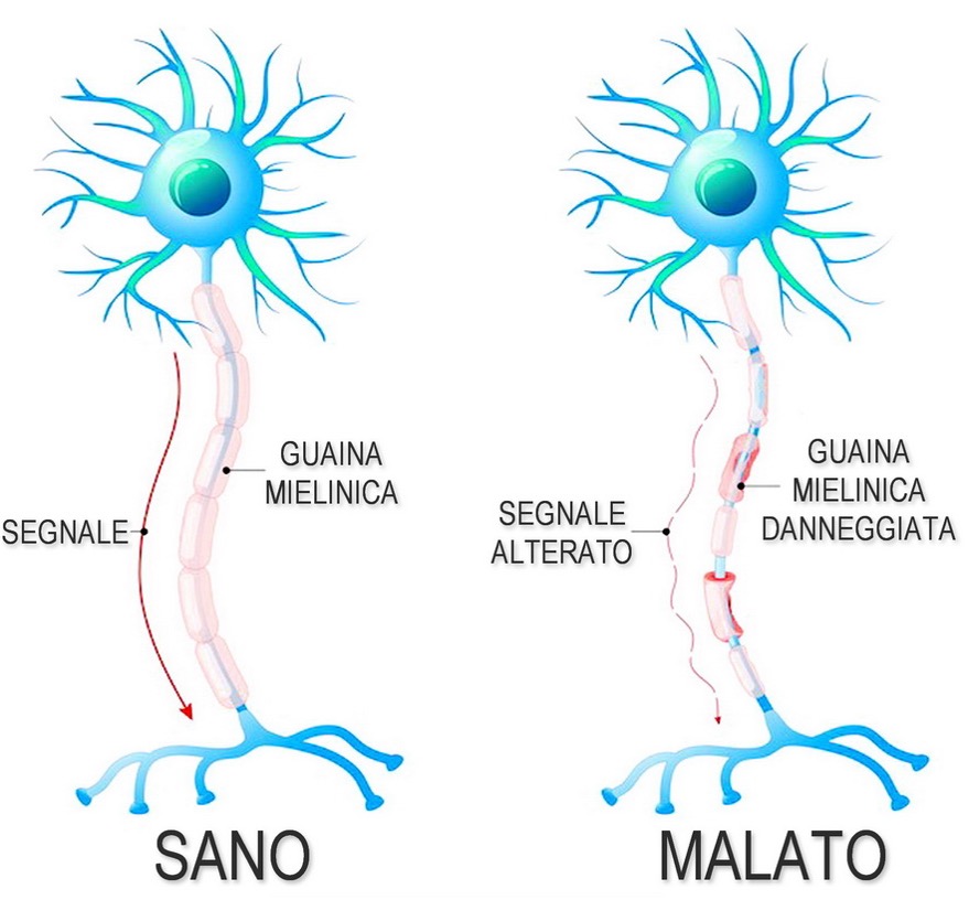 Malattie tossi-infettive, sono collegate alla sclerosi?