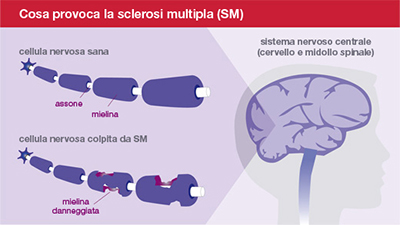 Autorizzato nel Regno Unito il primo studio clinico sulla terapia di rimielinizzazione PTD802