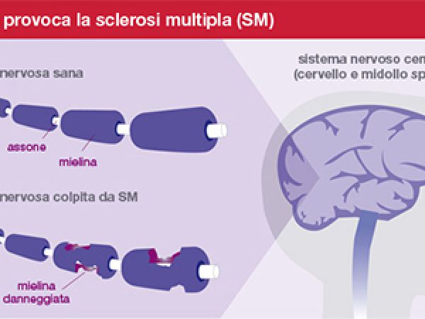 Autorizzato nel Regno Unito il primo studio clinico sulla terapia di rimielinizzazione PTD802