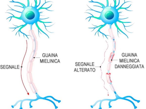 Malattie tossi-infettive, sono collegate alla sclerosi?