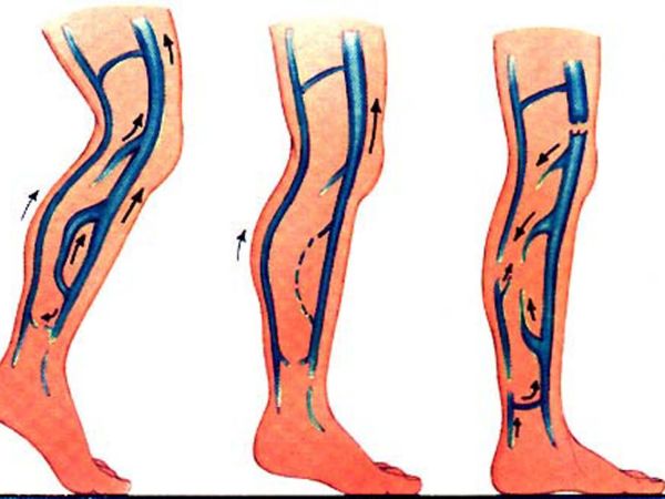 UNA NUOVA TECNICA CHIRURGICA NEL TRATTAMENTO DELLA SINDROME POST TROMBOTICA